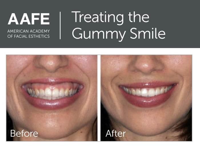 Botox & Dermal Fillers Laramie, WY